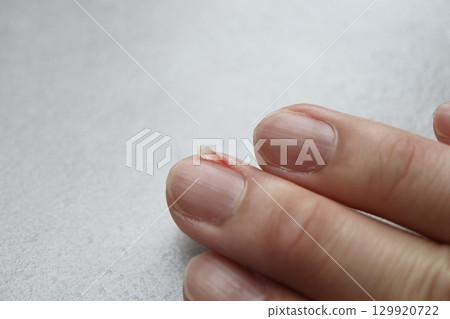 A broken middle fingernail due to an injury. Close-up of slight bleeding. 129920722