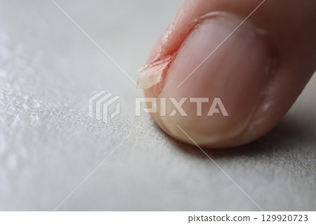A broken middle fingernail due to an injury. Close-up of slight bleeding. 129920723