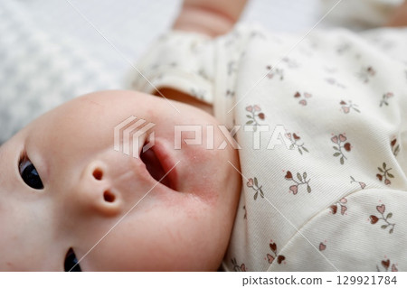 A 5-month-old baby girl with redness around her mouth due to drool rash 129921784