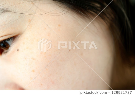 Close-up of melasma on a woman's cheek 129921787