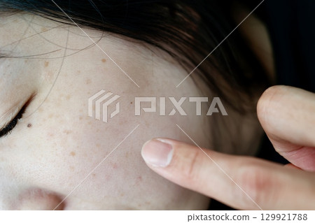 Close-up of melasma on a woman's cheek 129921788