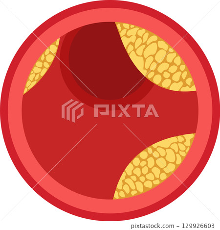 Illustration showing a blood vessel with plaque buildup, a visual representation of atherosclerosis. 129926603