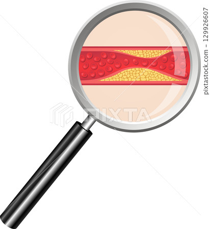 Magnified Artery: Atherosclerosis close-up showing plaque buildup and reduced blood flow. 129926607