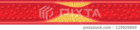 Blood vessel with plaque buildup, a health issue that can lead to cardiovascular problems. 129926609