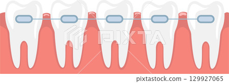 Dental braces on teeth illustration showing the orthodontic treatment for teeth alignment. 129927065