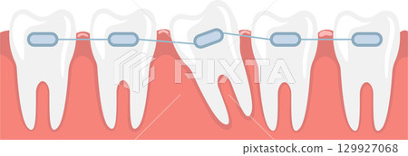 Dental Braces Correcting Malocclusion: A Visual Representation of Orthodontic Treatment 129927068