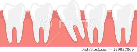 Dental illustration of teeth with one being impacted, causing potential alignment issues. 129927069