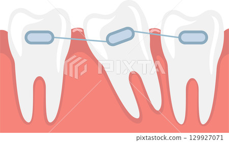 Illustration of teeth with braces, showing an impacted tooth being pulled into correct position. 129927071