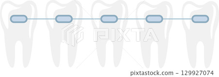 Illustration of five teeth aligned with dental braces, symbolizing orthodontic treatment. Illustration of five teeth aligned with dental braces, symbolizing orthodontic treatment. 129927074