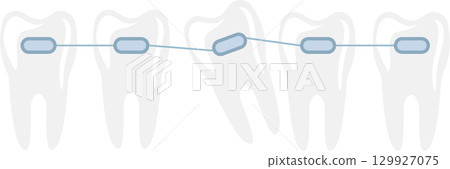 Dental Braces Adjusting Crooked Tooth: Orthodontic treatment straightening teeth with fixed appliance. Dental Braces Adjusting Crooked Tooth: Orthodontic treatment straightening teeth with fixed appliance. 129927075