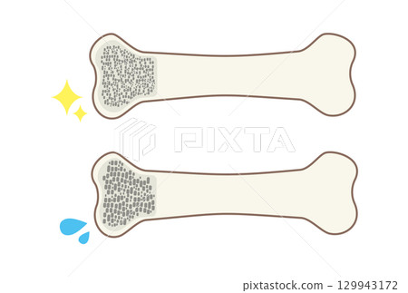 An illustration comparing bone density between strong and weak bones 129943172