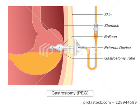 Gastrostomy is a procedure in which a gastrostomy tube. Gastrostomy is a procedure in which a gastrostomy tube. 129944589