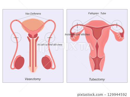 Sterilization is any of several medical methods of permanent birth control . Sterilization is any of several medical methods of permanent birth control . 129944592