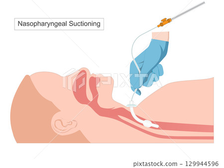 Tracheal suctioning is a common procedure performed in mechanically ventilated patients 129944596