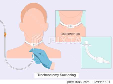 Tracheal suctioning is performed to remove secretions from the tracheostomy tube 129944601