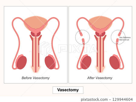 Vasectomy is a surgical procedure for permanent contraception in men involving cutting. 129944604