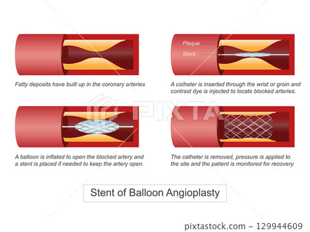 Balloon angioplasty is a minimally invasive procedure to widen narrowed or blocked arteries Balloon angioplasty is a minimally invasive procedure to widen narrowed or blocked arteries 129944609