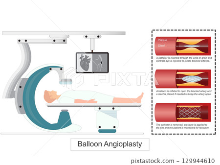 Balloon Angioplasty or Percutaneous coronary intervention (PCI) Balloon Angioplasty or Percutaneous coronary intervention (PCI) 129944610