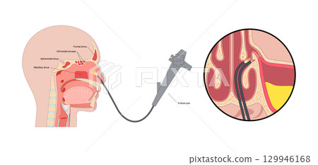 Functional Endoscopic Sinus Surgery 129946168