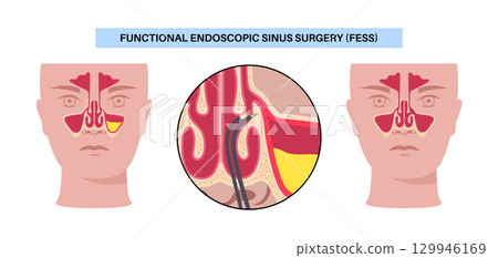 Functional Endoscopic Sinus Surgery 129946169