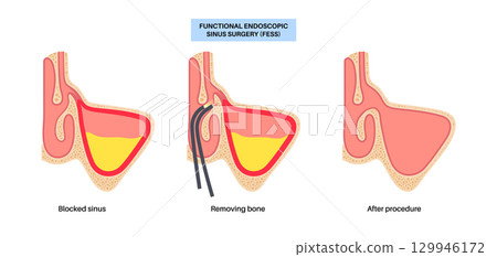 Functional Endoscopic Sinus Surgery 129946172