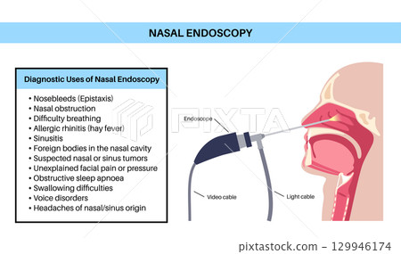 Nasal endoscopy poster Nasal endoscopy poster 129946174