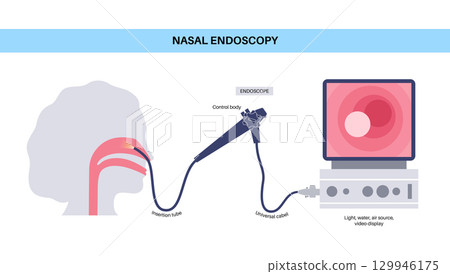 Nasal endoscopy poster Nasal endoscopy poster 129946175