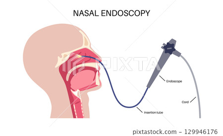 Nasal endoscopy poster Nasal endoscopy poster 129946176