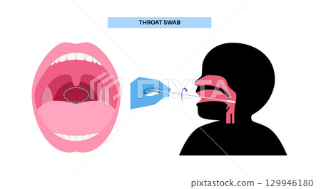 Swab throat procedure 129946180