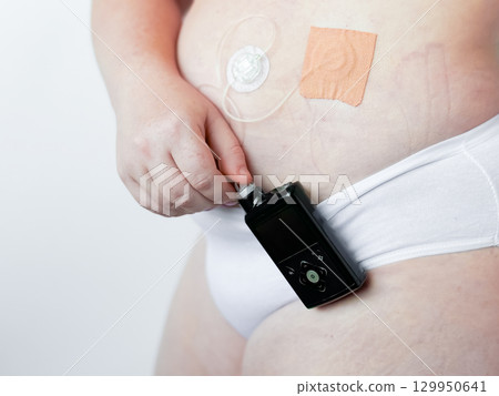 Adult caucasian female using insulin pump for diabetes management 129950641