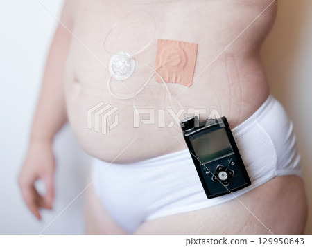 Young caucasian child with insulin pump device on abdomen for diabetes management 129950643