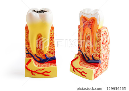 Decay tooth replace with dental implant root canal teeth model for education isolated on white background. 129956265