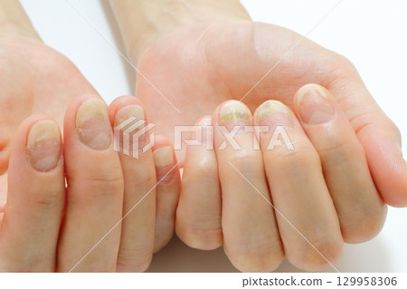 Nail problems (onycholysis and green onychomycosis) Nail problems (onycholysis and green onychomycosis) 129958306