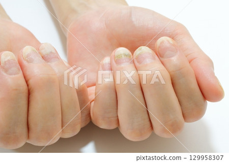 指甲問題（甲剝離和綠色甲癬） 129958307