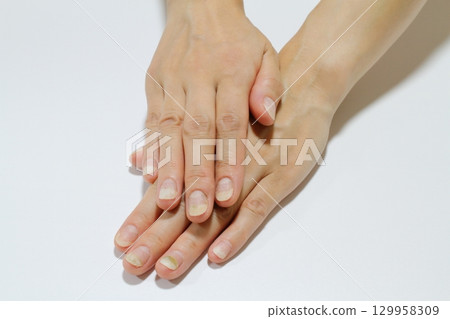 Nail problems (onycholysis and green onychomycosis) 129958309