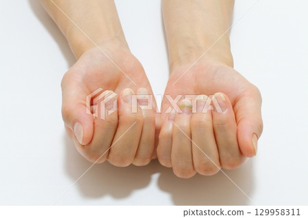 Nail problems (onycholysis and green onychomycosis) 129958311