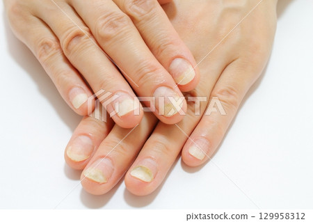 指甲問題（甲剝離和綠色甲癬） 129958312