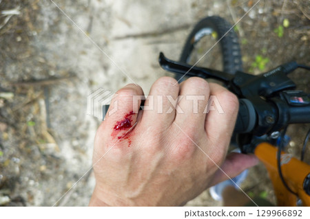 Arm injury while riding mountain bike on Florida jungle trails. Red bloody wound from hitting a tree stump. Biking accident Arm injury while riding mountain bike on Florida jungle trails. Red bloody wound from hitting a tree stump. Biking accident 129966892