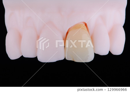 Mirror copy of central maxillary incisor, ultra thin dental ceramic veneer or crown on printed model Mirror copy of central maxillary incisor, ultra thin dental ceramic veneer or crown on printed model 129966966