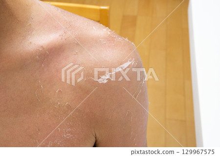 Peeling after sunburn Peeling after sunburn 129967575
