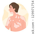 Young Man with Vitiligo Disease on Body Skin for Dermatological Symptom Concept Illustration Clip Art 129971754