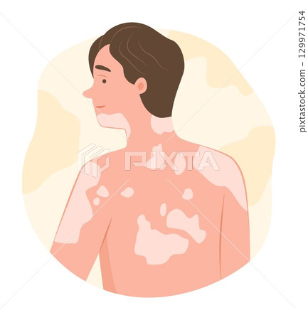 Young Man with Vitiligo Disease on Body Skin for Dermatological Symptom Concept Illustration Clip Art 129971754