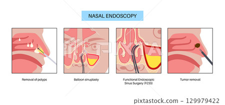 Nasal endoscopy poster Nasal endoscopy poster 129979422