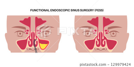 Functional Endoscopic Sinus Surgery 129979424