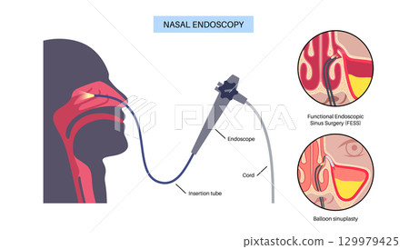 Nasal endoscopy poster Nasal endoscopy poster 129979425