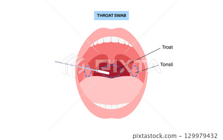 Swab throat procedure 129979432