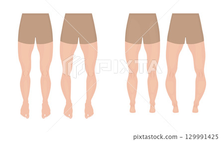 Normal legs and legs with genu varum and valgum, front and rear view Normal legs and legs with genu varum and valgum, front and rear view 129991425