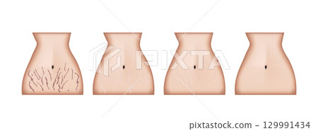 Woman body before and after stretch marks removal treatment 129991434
