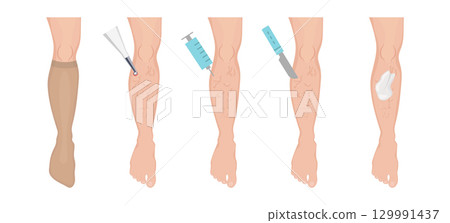 Treating varicose vein, compression stocking, laser, injection, surgery, bandage 129991437