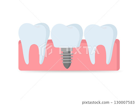 Dental implantation tooth restoration Vector illustration stock illustration Dental implantation tooth restoration Vector illustration stock illustration 130007583